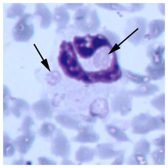 Human Ewingii Ehrlichiosis